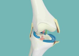 Medial Collateral Ligament (MCL) Tears