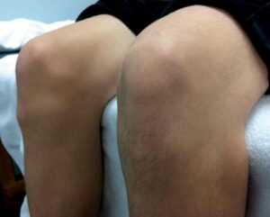 Osgood-Schlatter Disease